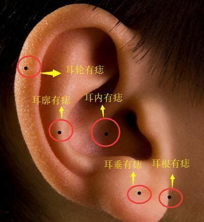 耳輪痣|左耳痣vs右耳痣：命運大不同